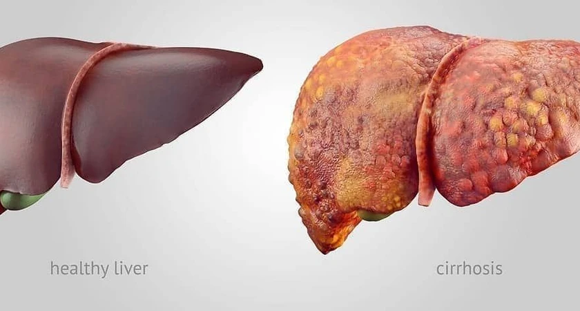 Comparaison entre un foie sain et un foie atteint de cirrhose, illustrant les différences de texture et de couleur.