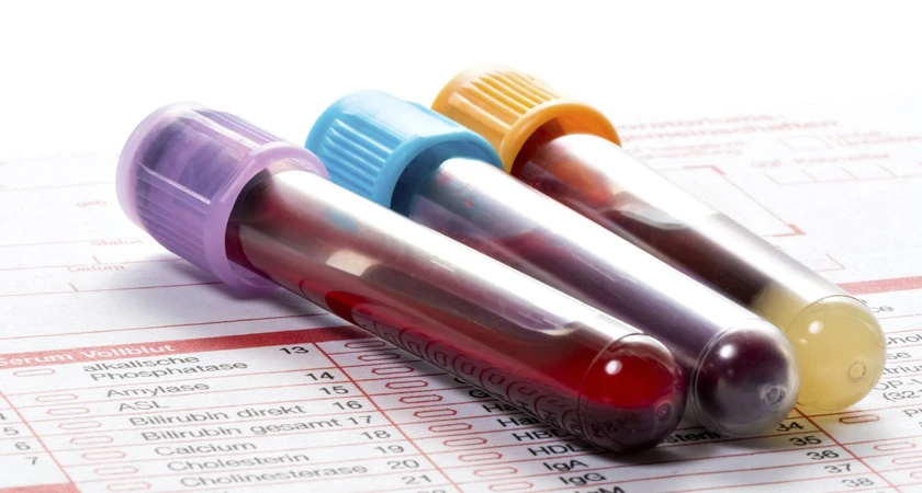 Trois tubes à essai remplis de sang posés sur un rapport d'analyse médicale.