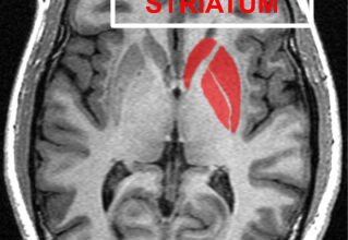 Image de cerveau prise en IRM anatomique. Il s'agit d'une coupe transversale (horizontale). Une zone spécifique, située sur la droite, en frontal, y est mise en avant : le striatum.