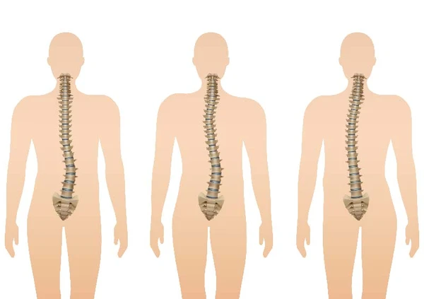 Tratamiento escoliosis en Valencia | Medical Exercise